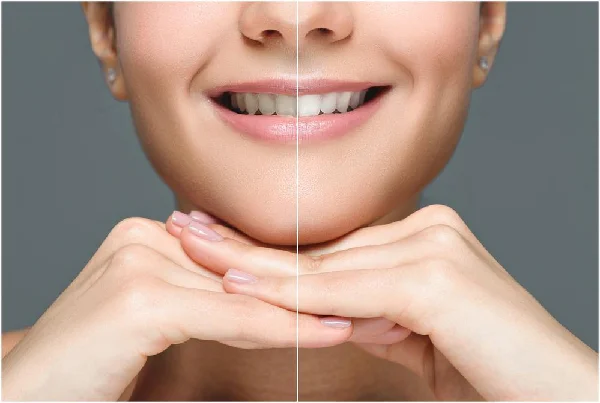 Scaling and Polishing at Singh Dental